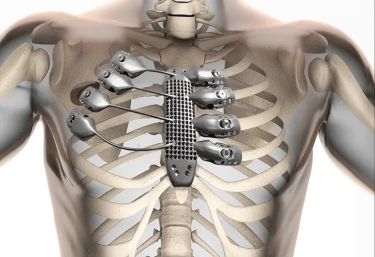titanium-bone-implant
