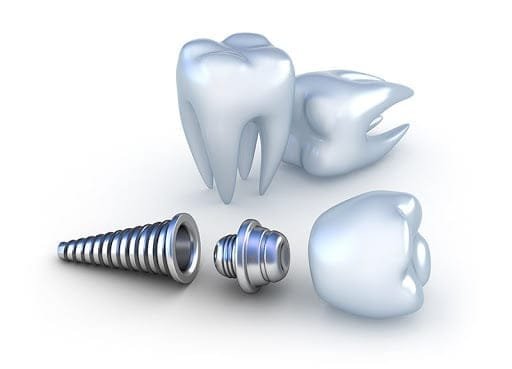titanium-in-tooth-use